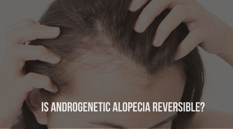 Is Androgenetic Alopecia Reversible?