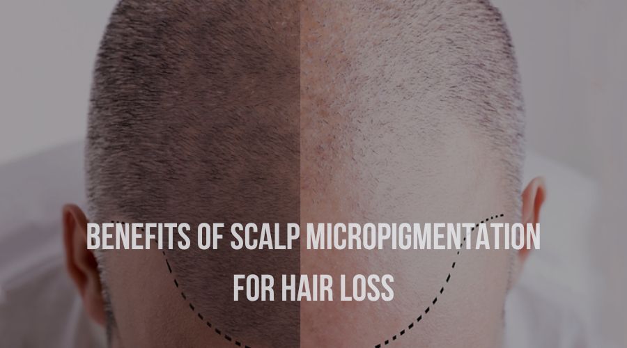 Benefits of Scalp Micropigmentation for Hair Loss