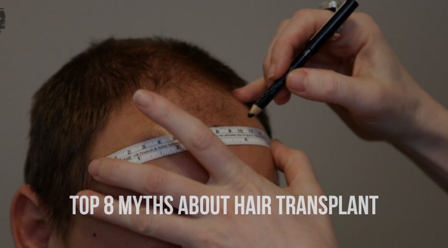 Top 8 Myths About Hair Transplant