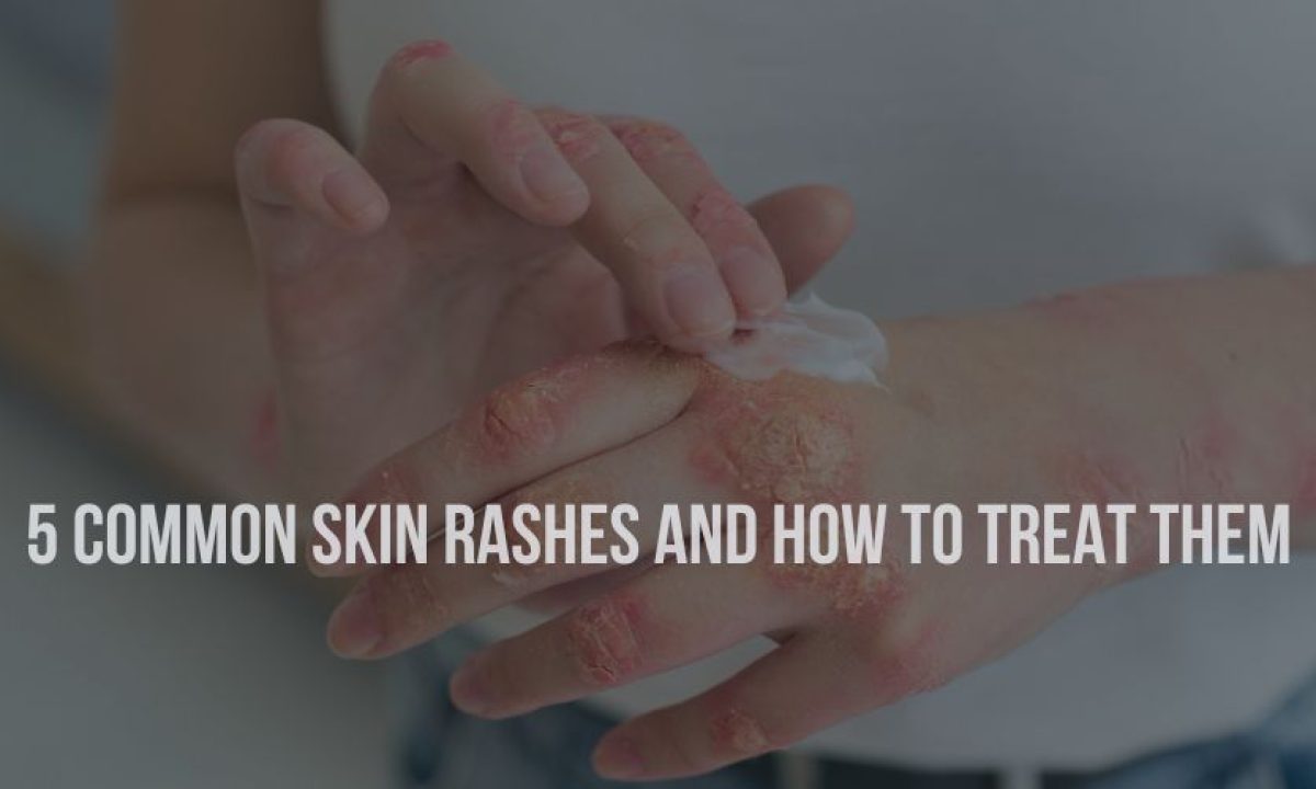 Common Skin Rashes On Palms