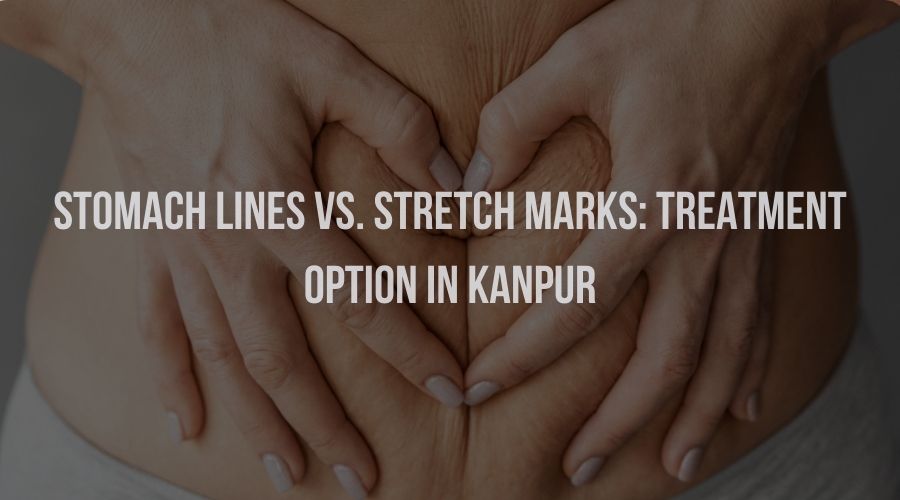 Stomach Lines vs. Stretch Marks: Treatment Option in Kanpur