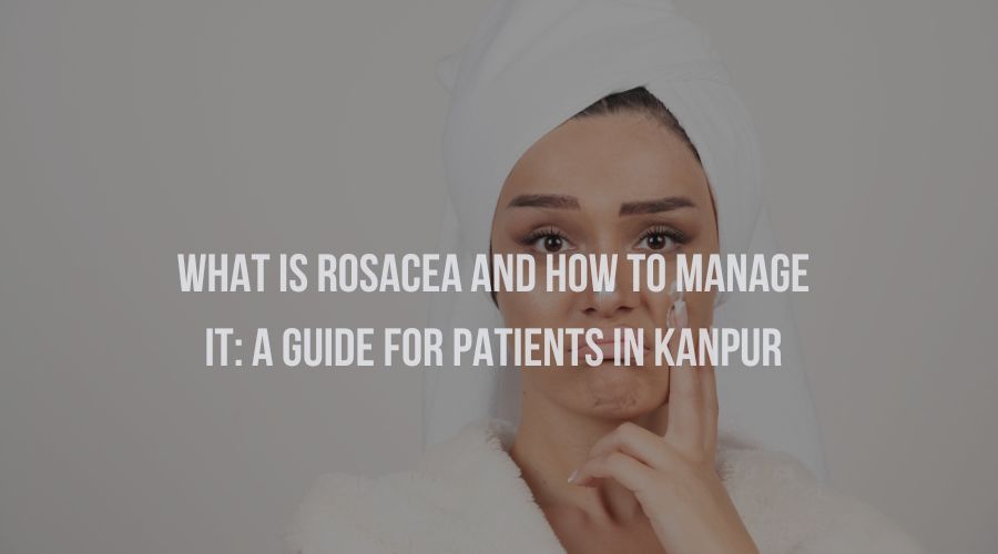 What is Rosacea and How to Manage It: A Guide for Patients In Kanpur