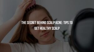 The Secret Behind Scalp Acne: Tips to Get a Healthy Scalp
