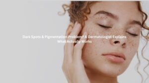 Close-up of a woman with freckles and facial pigmentation highlighting dark spots on skin