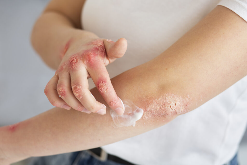 Skin hydration and barrier repair in eczema treatment in Kanpur with medicated cream application