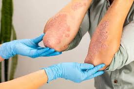 Eczema treatment in Kanpur showing dermatologist examining inflamed skin on arm