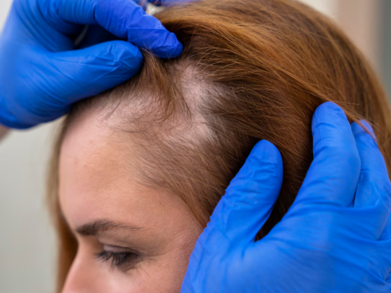Hair loss alopecia scalp examination treatment at Dermatrichs