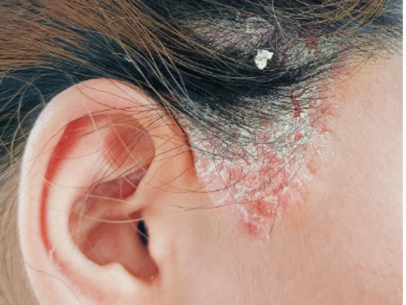 Scalp infection and inflammation treatment consultation at Dermatrichs