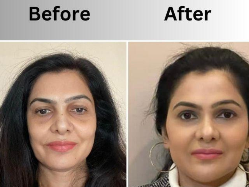 Natural facial lifting and rejuvenation results.