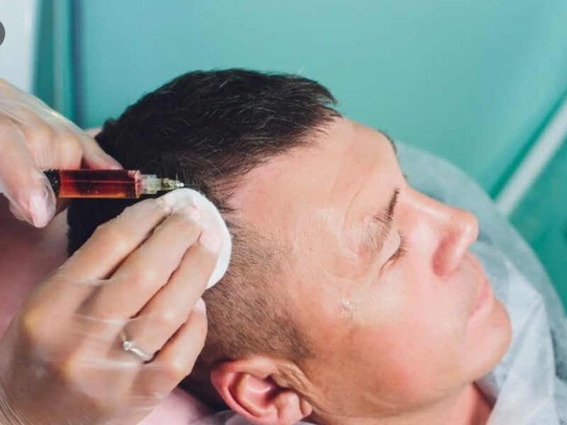 DHI FUE Hair Transplant procedure for natural hair restoration results