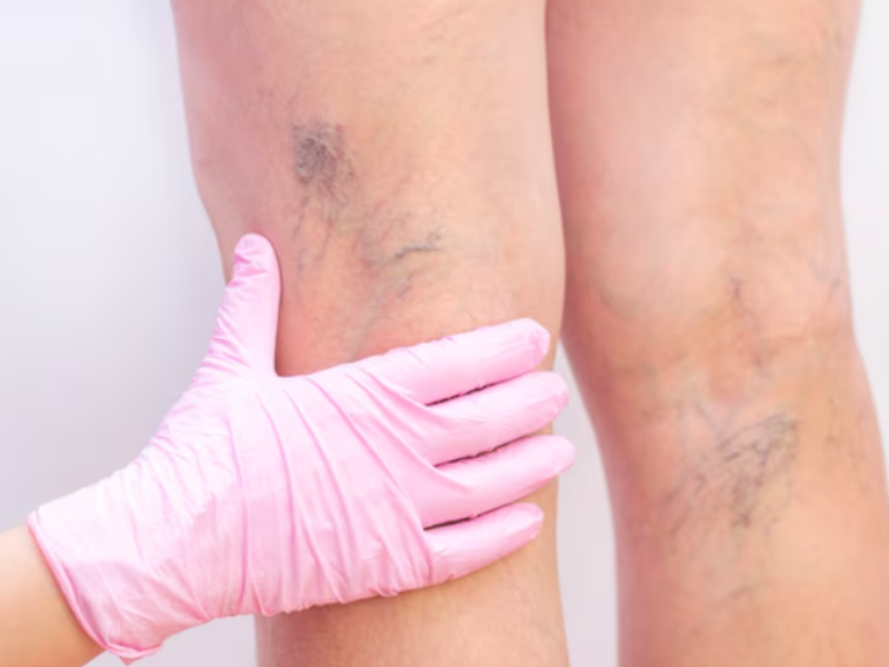 Advanced Spider Vein Removal treatment on legs with laser therapy before and after results